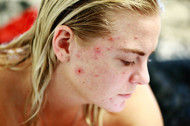 L'impact du stress sur votre peau